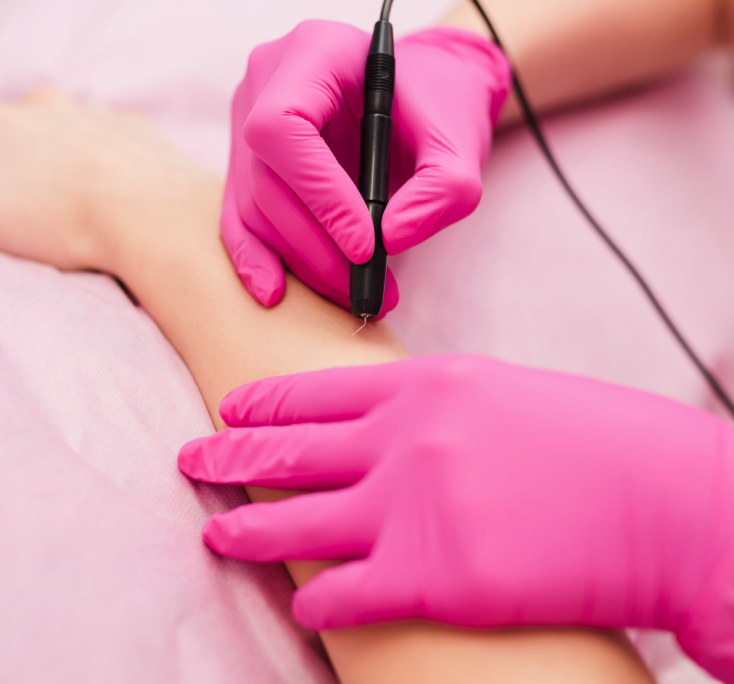 A wart being taken off in Bradford